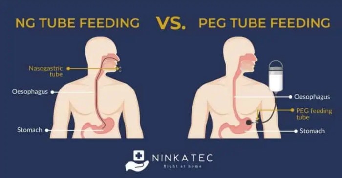 Explain the steps involved in providing an intermittent enteral feeding